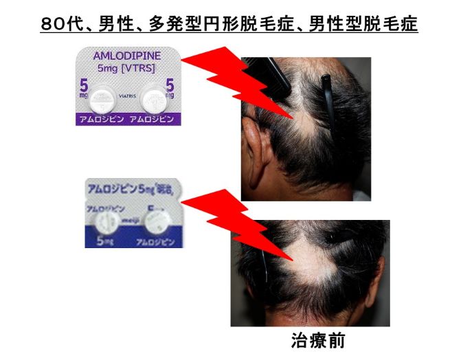 円形脱毛症　病院